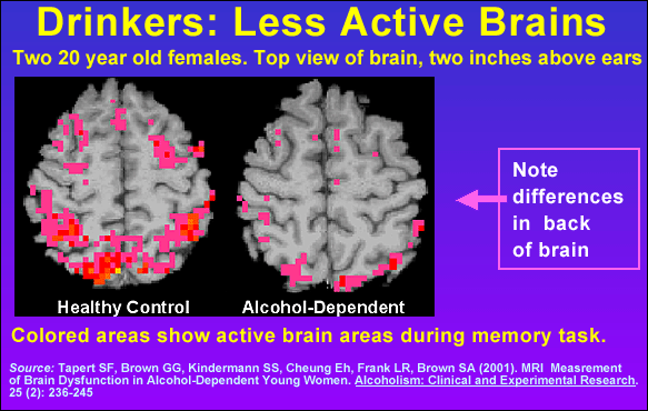 Drinkers: Less Active Brains
