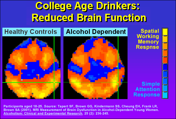 College Age Drinkers: Reduced Brain Function