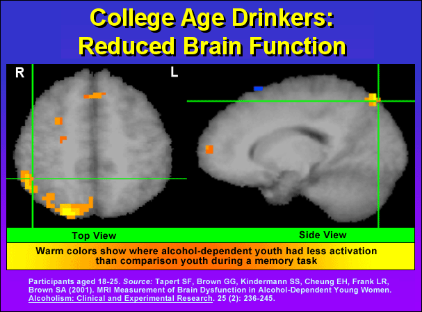 College Age Drinkers: Reduced Brain Function